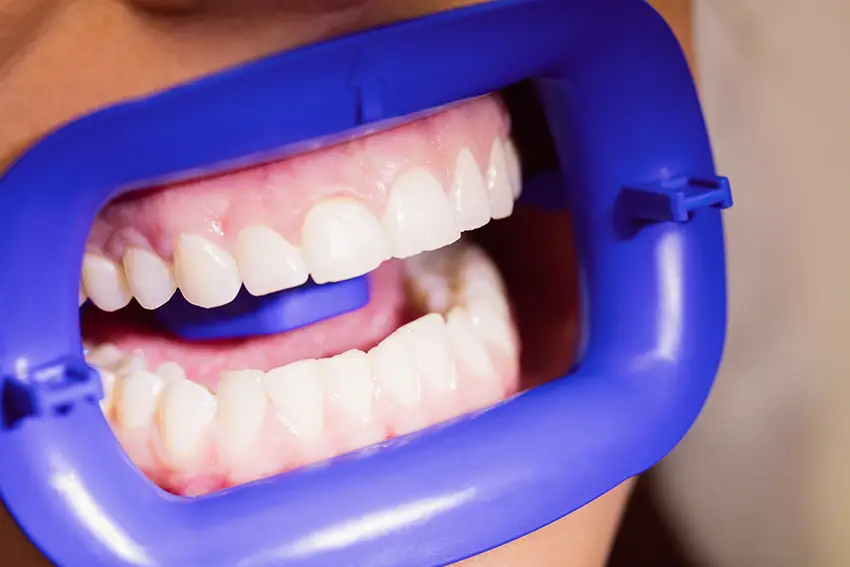 لمینت دندان بدون تراش : راز لبخندی زیبا و سالم بدون هیچ‌گونه آسیب به دندان‌ها