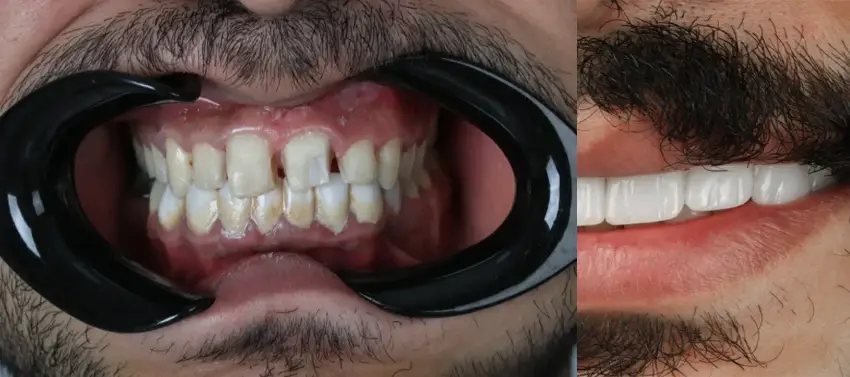 لمینت دندان‌های نامرتب: راهی ساده و مؤثر برای داشتن لبخندی زیبا