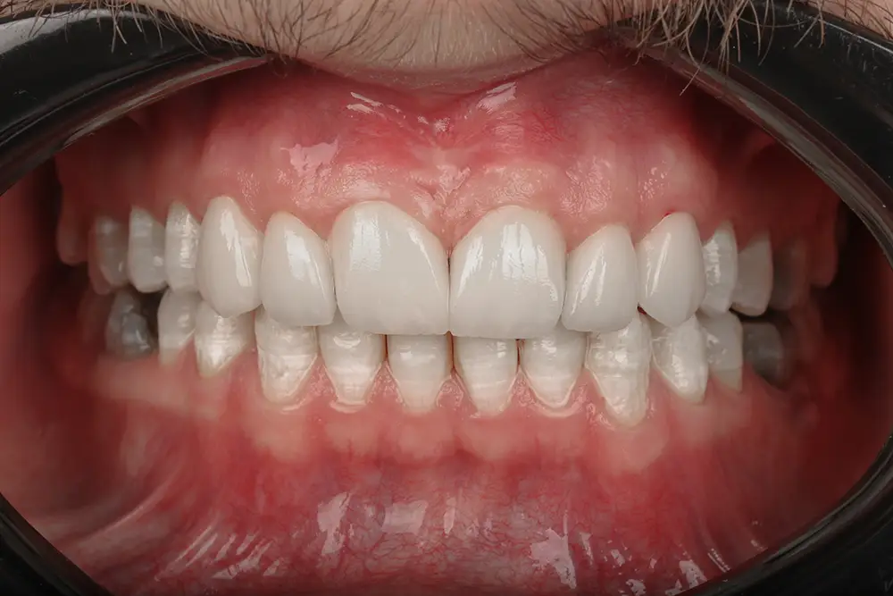 تصویر بعد از درمان