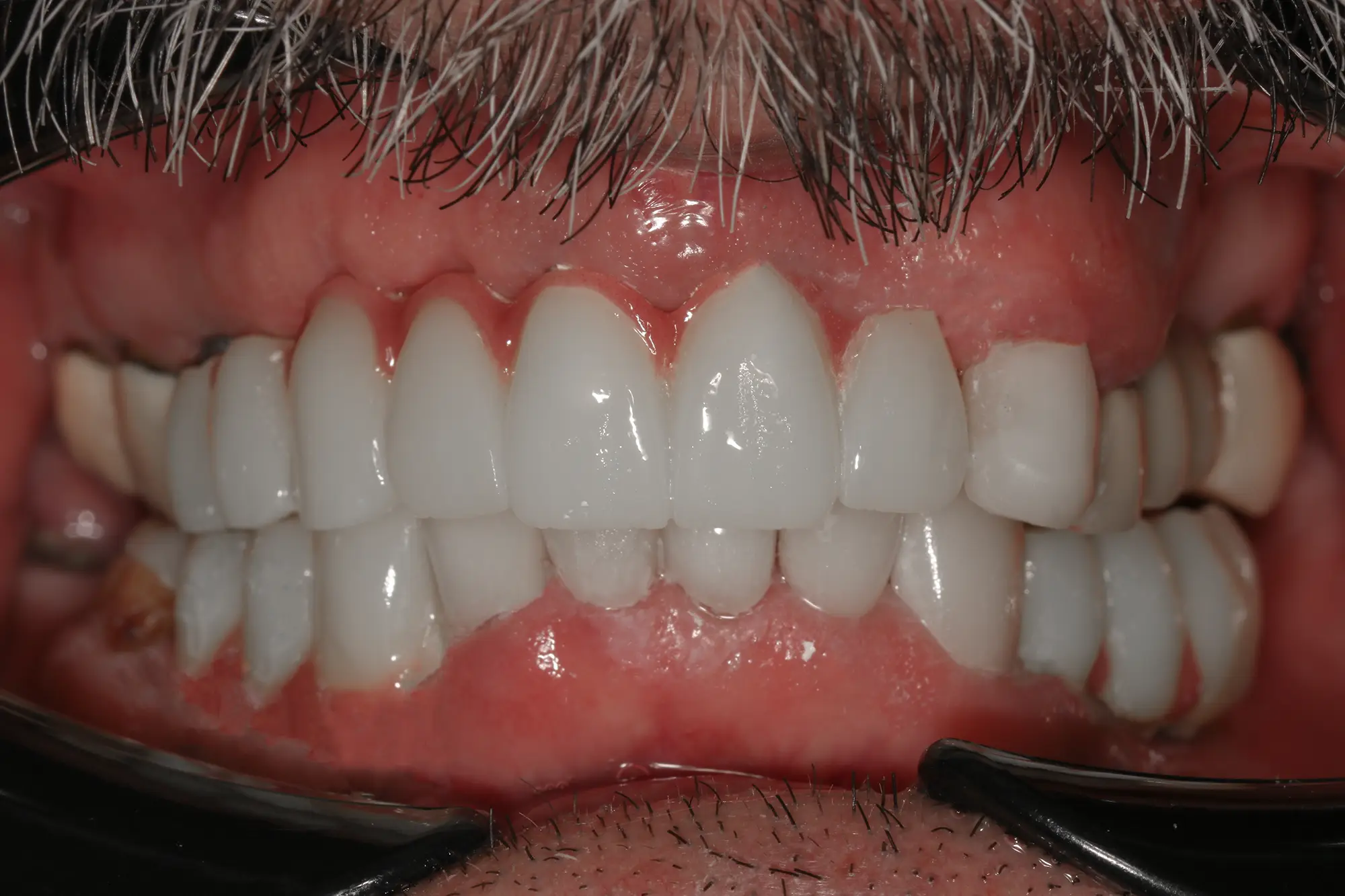 تصویر بعد از درمان