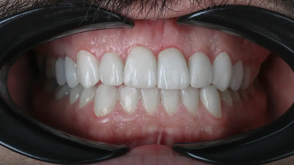 تصویر بعد از درمان