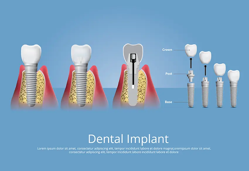 ایمپلنت دندان در جردن تهران راهنمای کامل ایمپلنت دندان