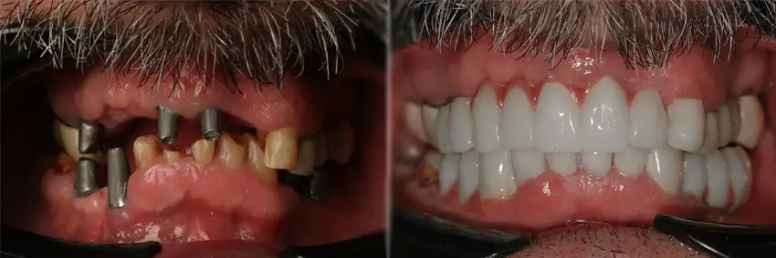 نمونه کار ایمپلنت مقاله ایمپلنت دندان در جردن تهران راهنمای کامل ایمپلنت دندان