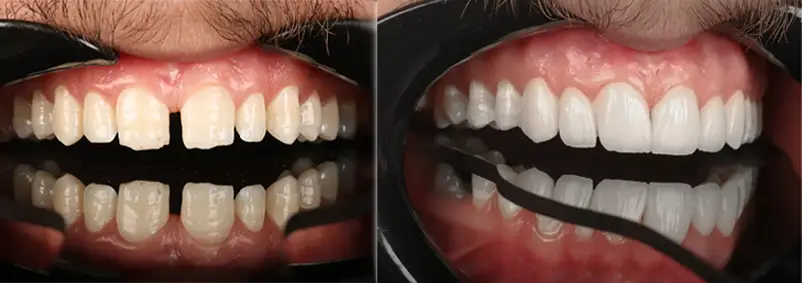 عکس قبل بعد لبخند رویایی با دندانپزشکی زیبایی در جردن تهران در ۱۴۰۴