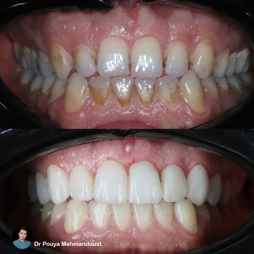 لمینت سرامیکی در جردن: مزایا و معایب